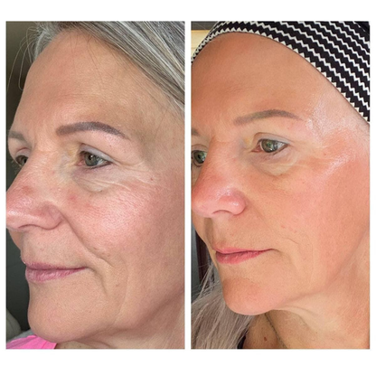 Korean CactoLift V-Band - Cooling & Pore Tightening™