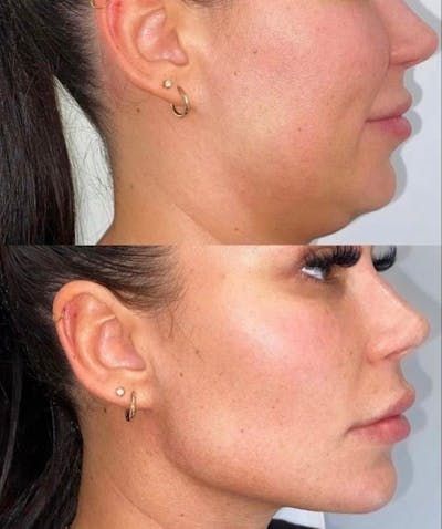 Korean CactoLift V-Band - Cooling & Pore Tightening™